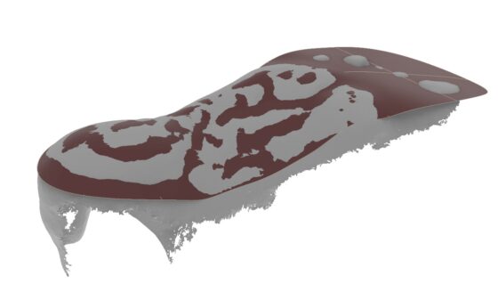 Vacuum Formed Foot Orthotic